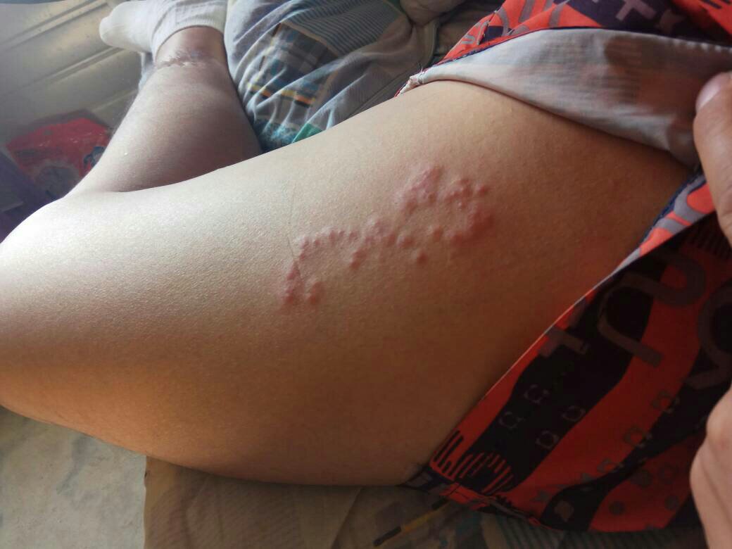 身上痒像虫子爬一样