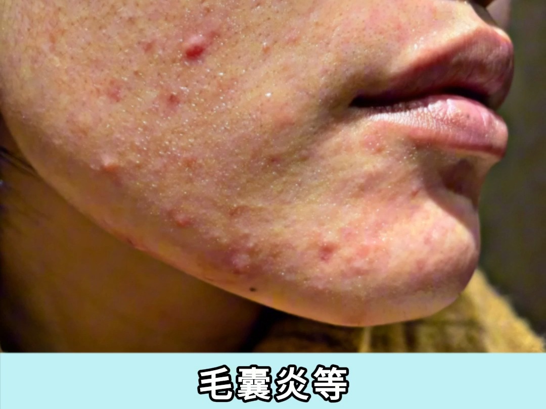 脸上有螨虫怎么治疗?