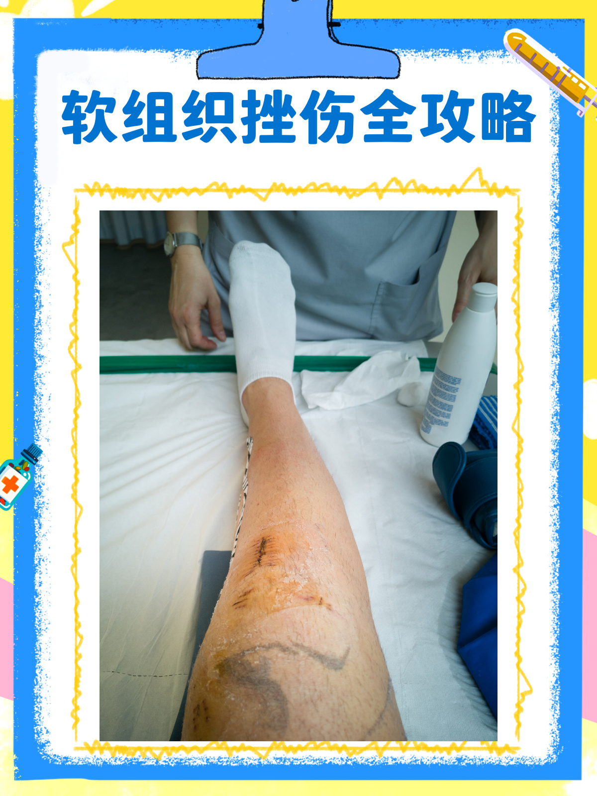脚软组织挫伤能自愈吗