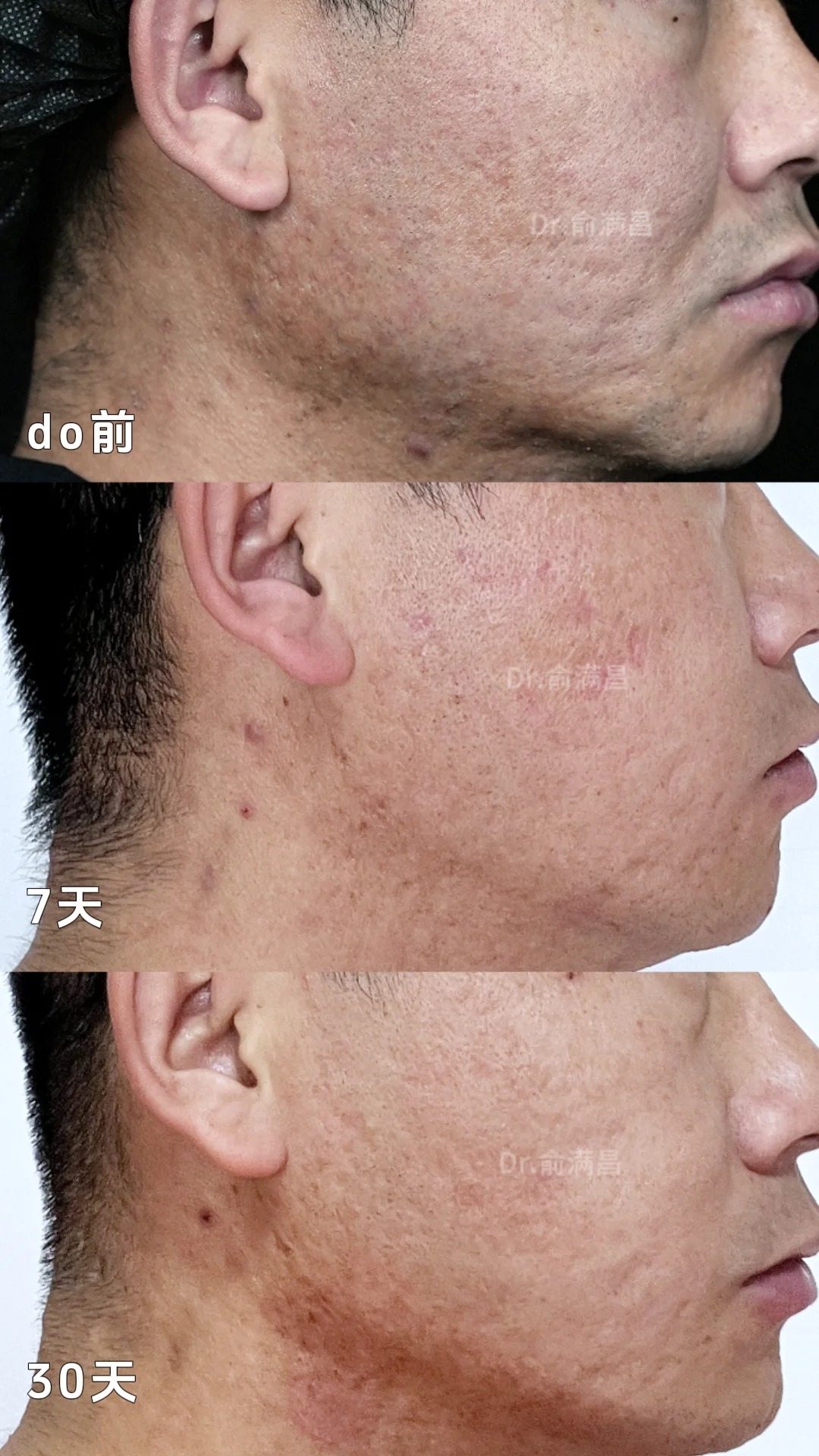 痘印痘坑如何修复