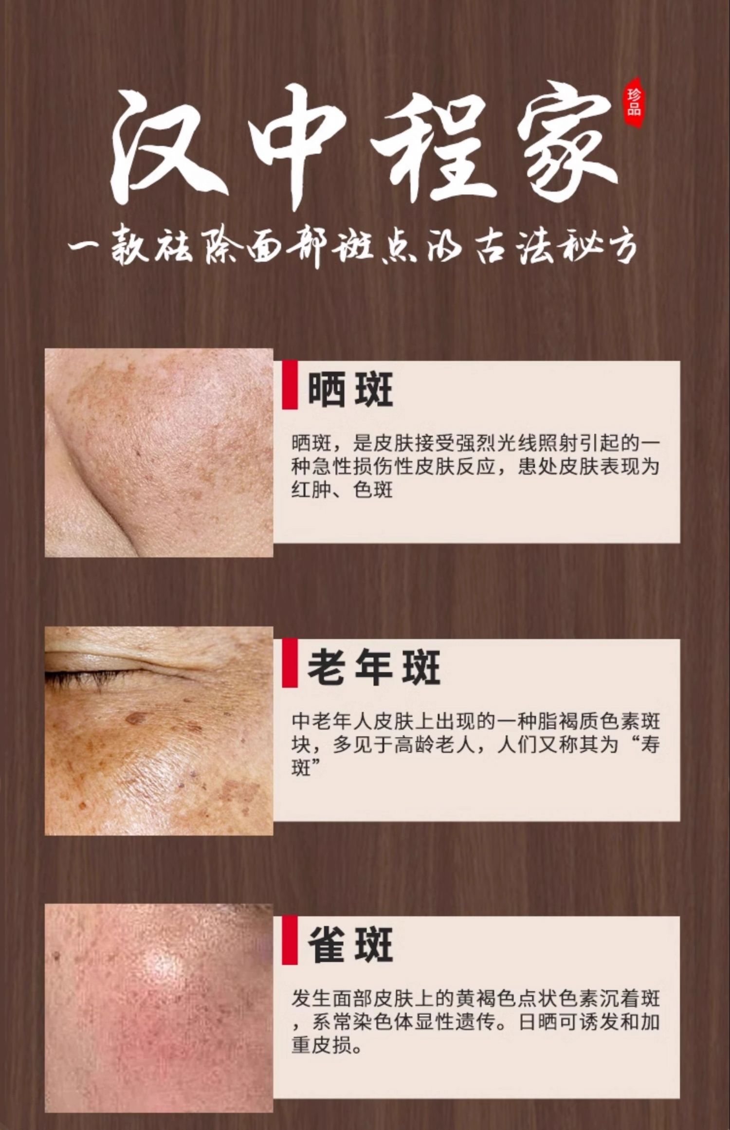 去雀斑最有效的方法