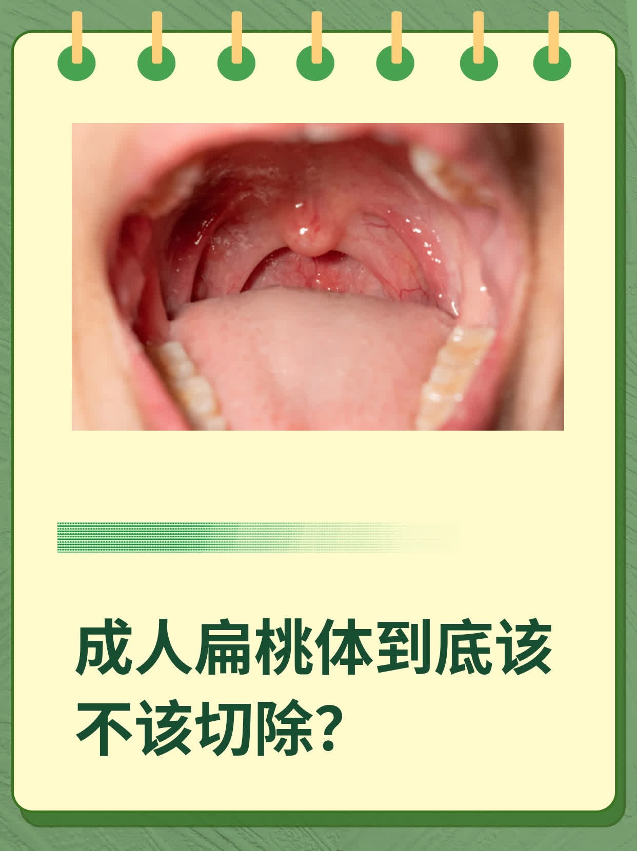 成人扁桃体炎怎么治疗