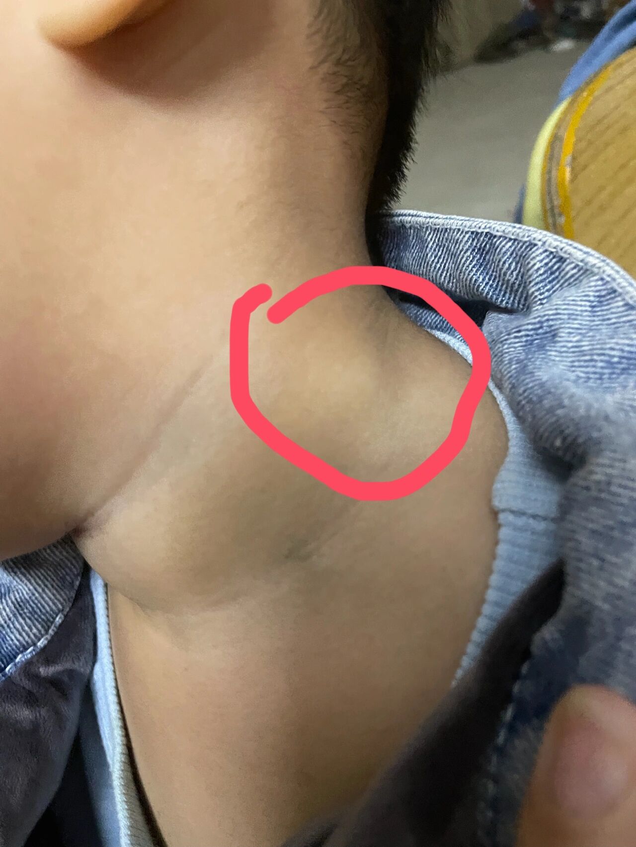 颈部淋巴结炎症状