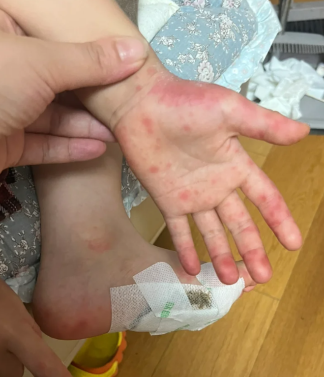 成人感染手足口病有什么症状