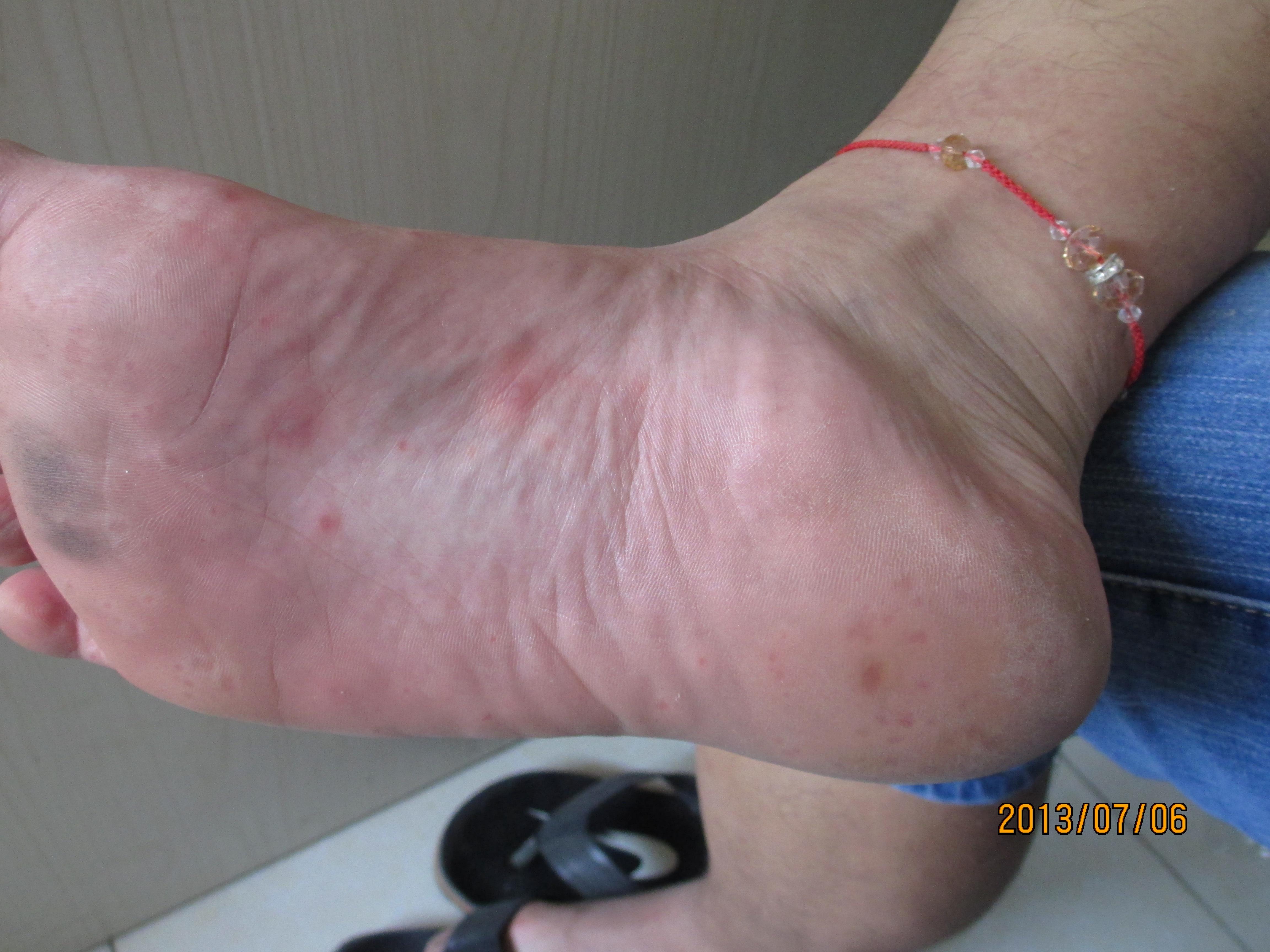 成人感染手足口病有什么症状