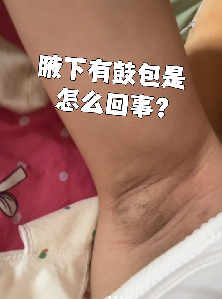 腋窝下有副乳怎么办