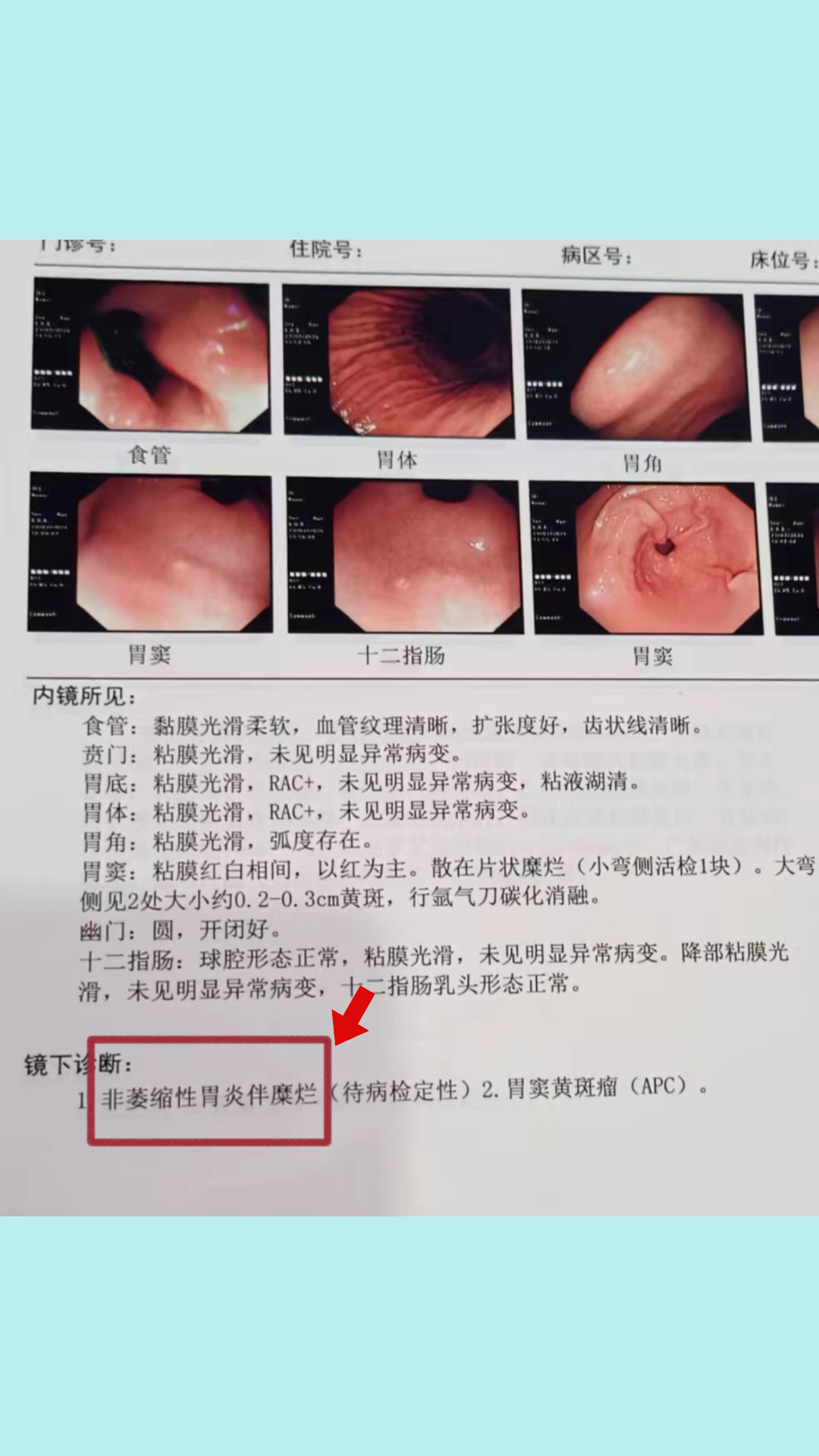 非萎缩性胃炎严重吗?