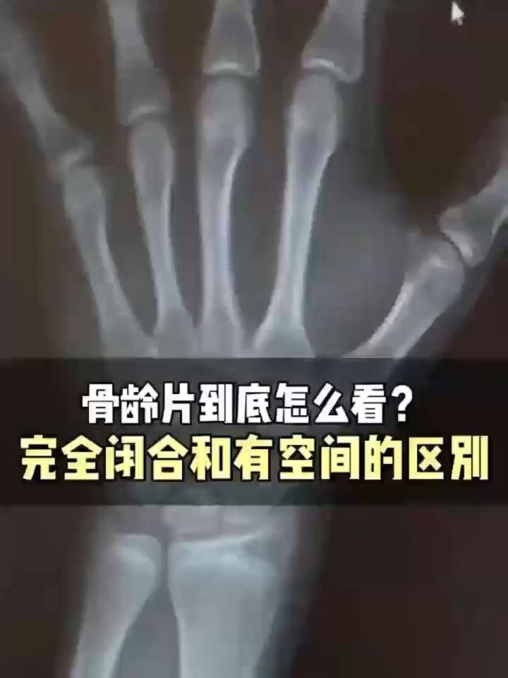 这是我的X光片,看看骨骺线有没闭合???