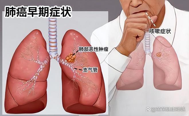 肺癌早期症状都有哪些