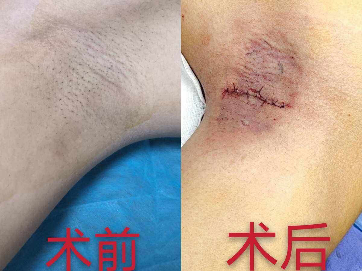 手术治疗狐臭