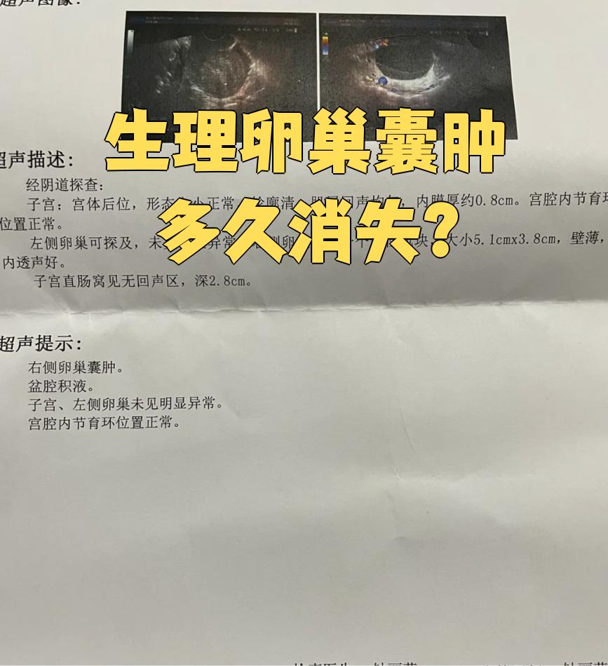 卵巢囊肿对月经有影响吗