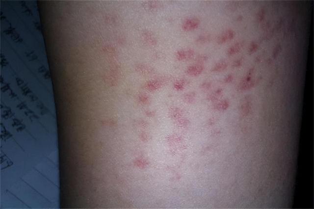 慢性白血病的早期症状