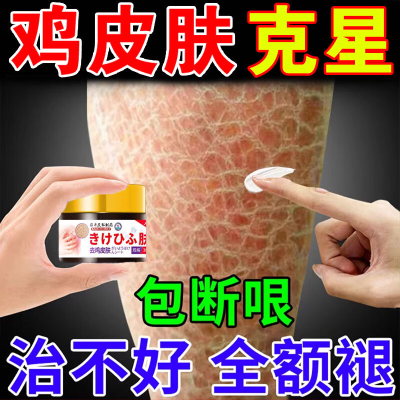 毛囊角化症用什么药膏