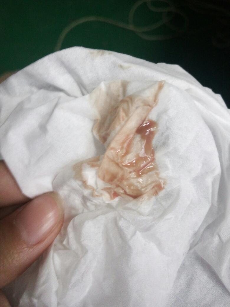 怀孕一个月流产症状是什么