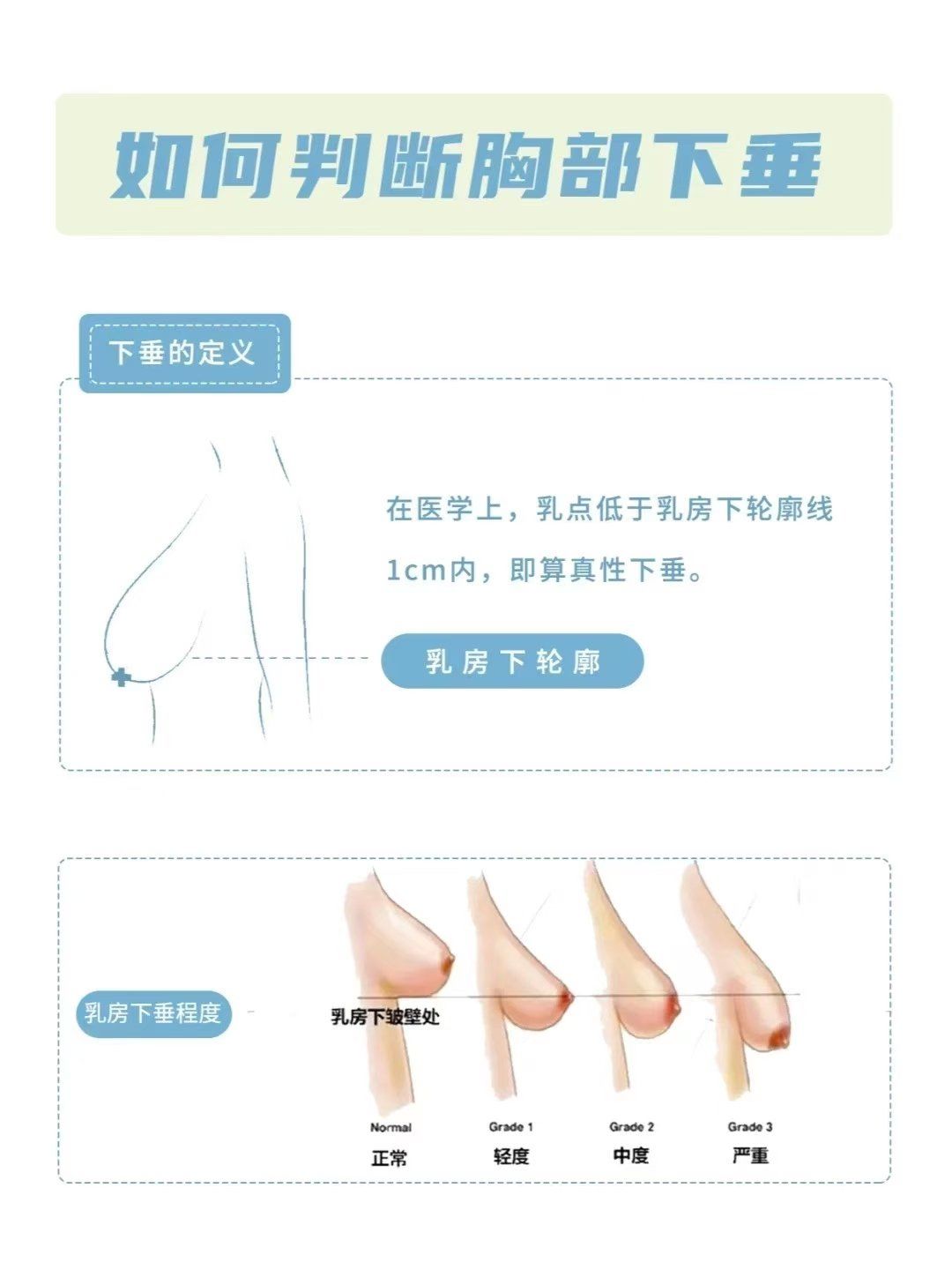 乳房下垂能恢复从前吗?