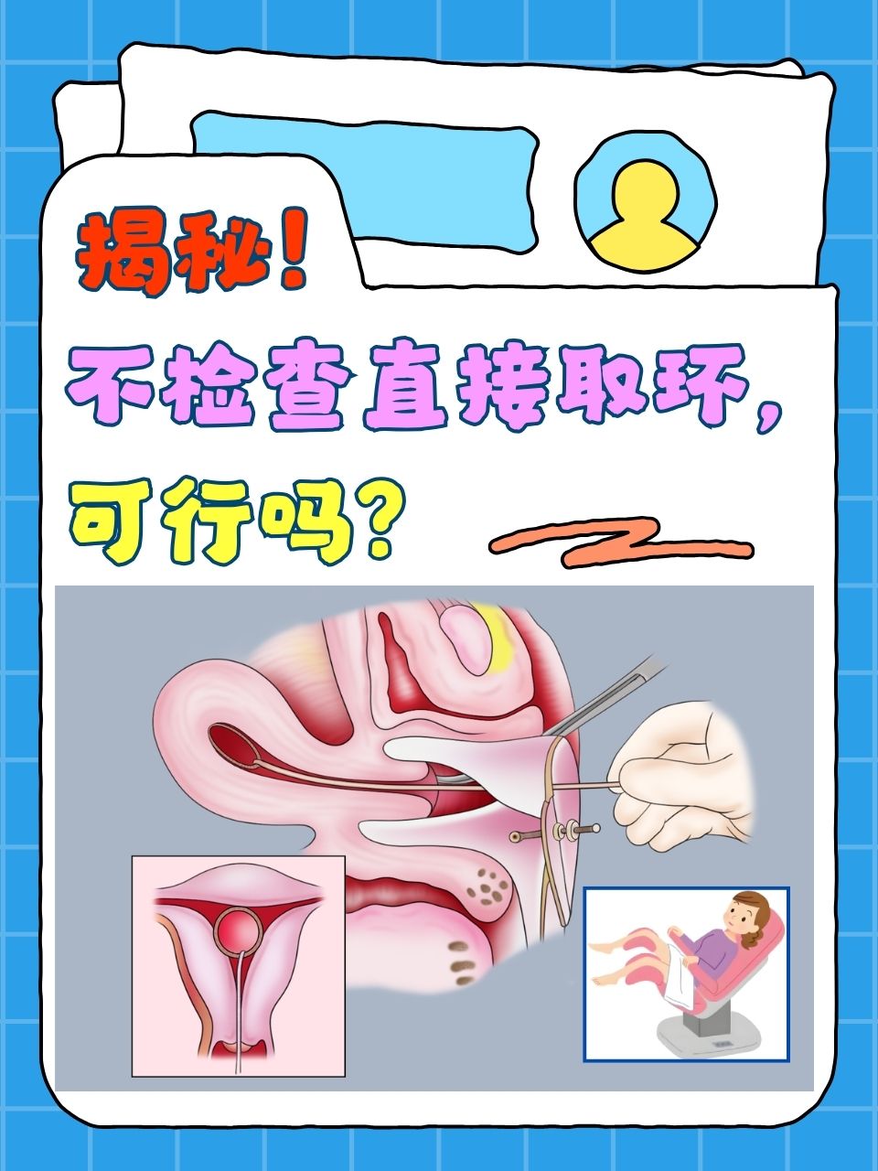 放环多久可以同房