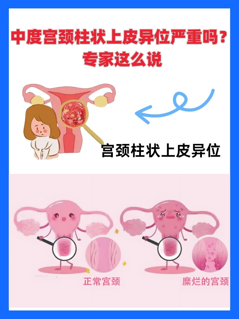 中度宫颈糜烂严重吗