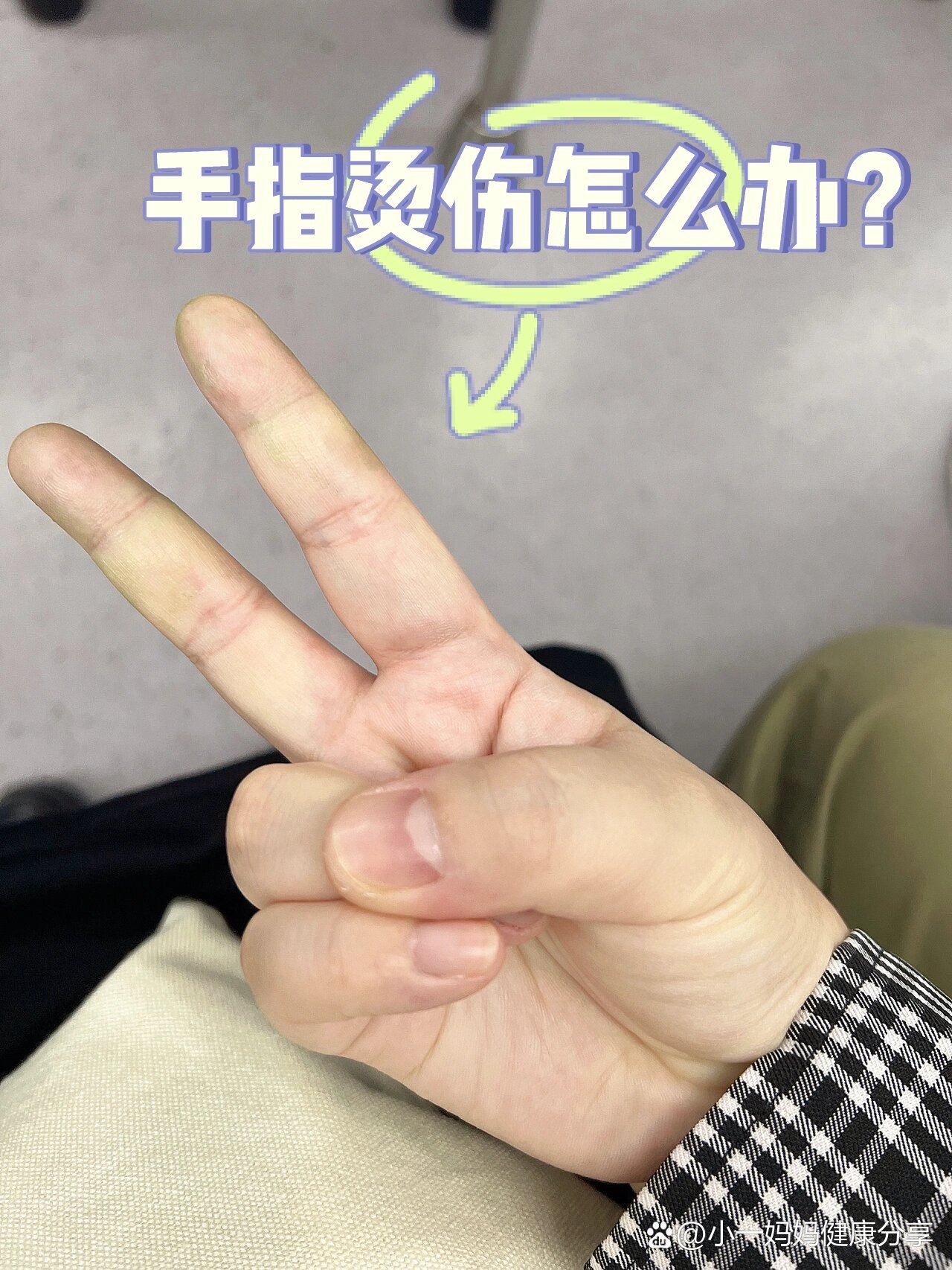 手被烫伤了怎么办