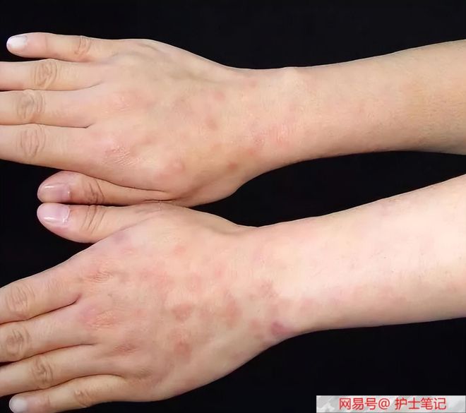 性病的早期症状