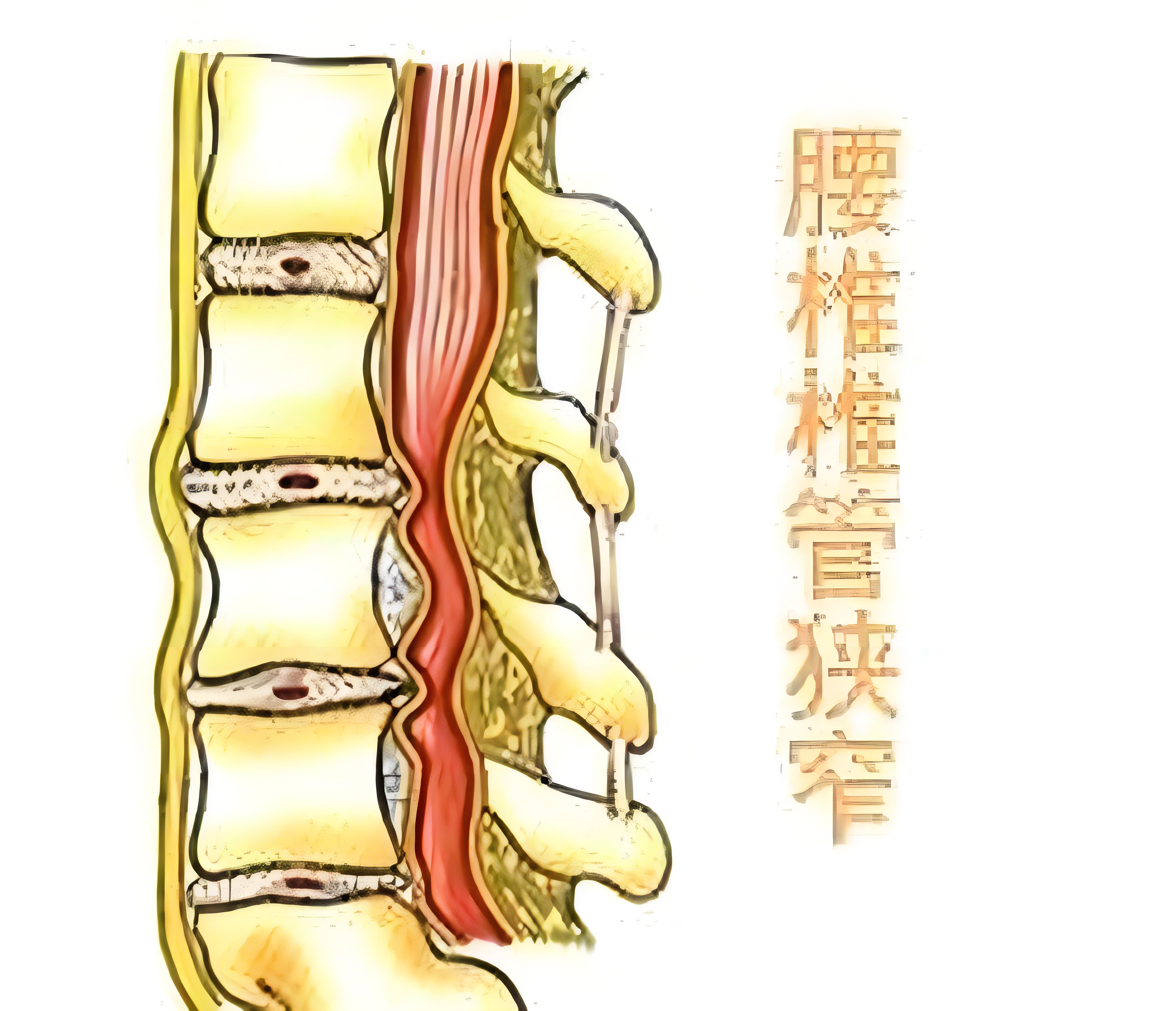 腰椎管狭窄症状有哪些