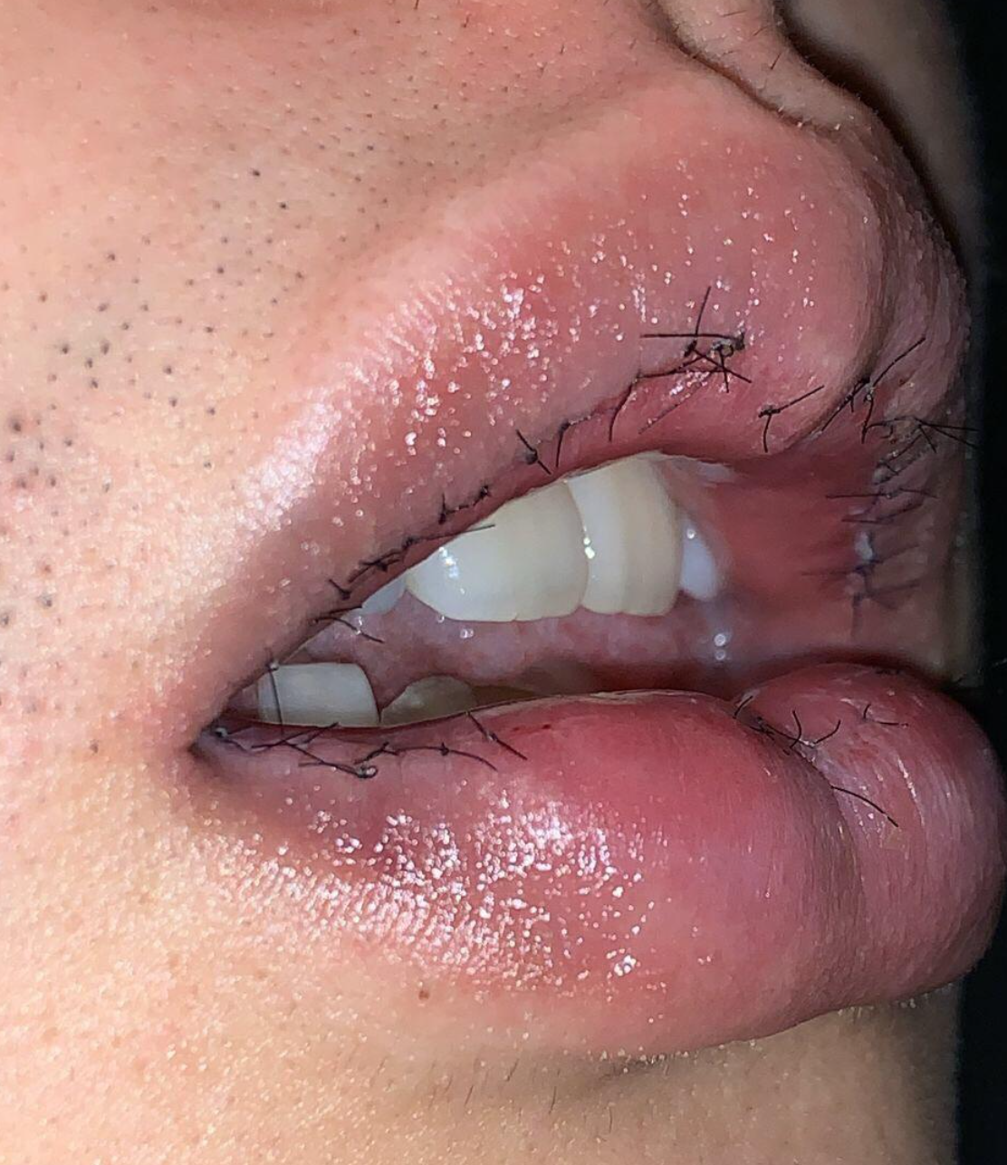 嘴唇变薄我该怎么办呢