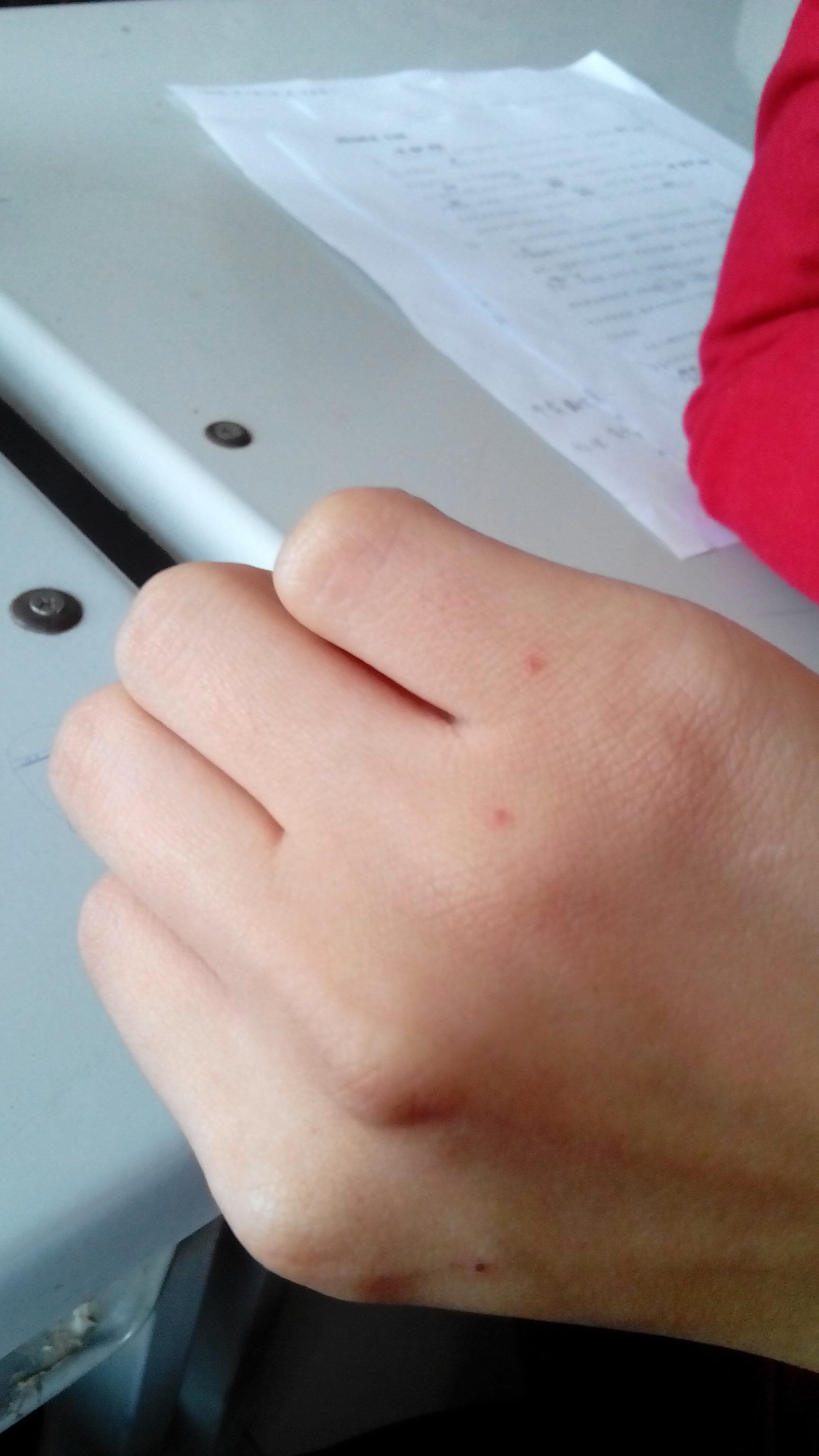 手上有小红点,不痛不痒