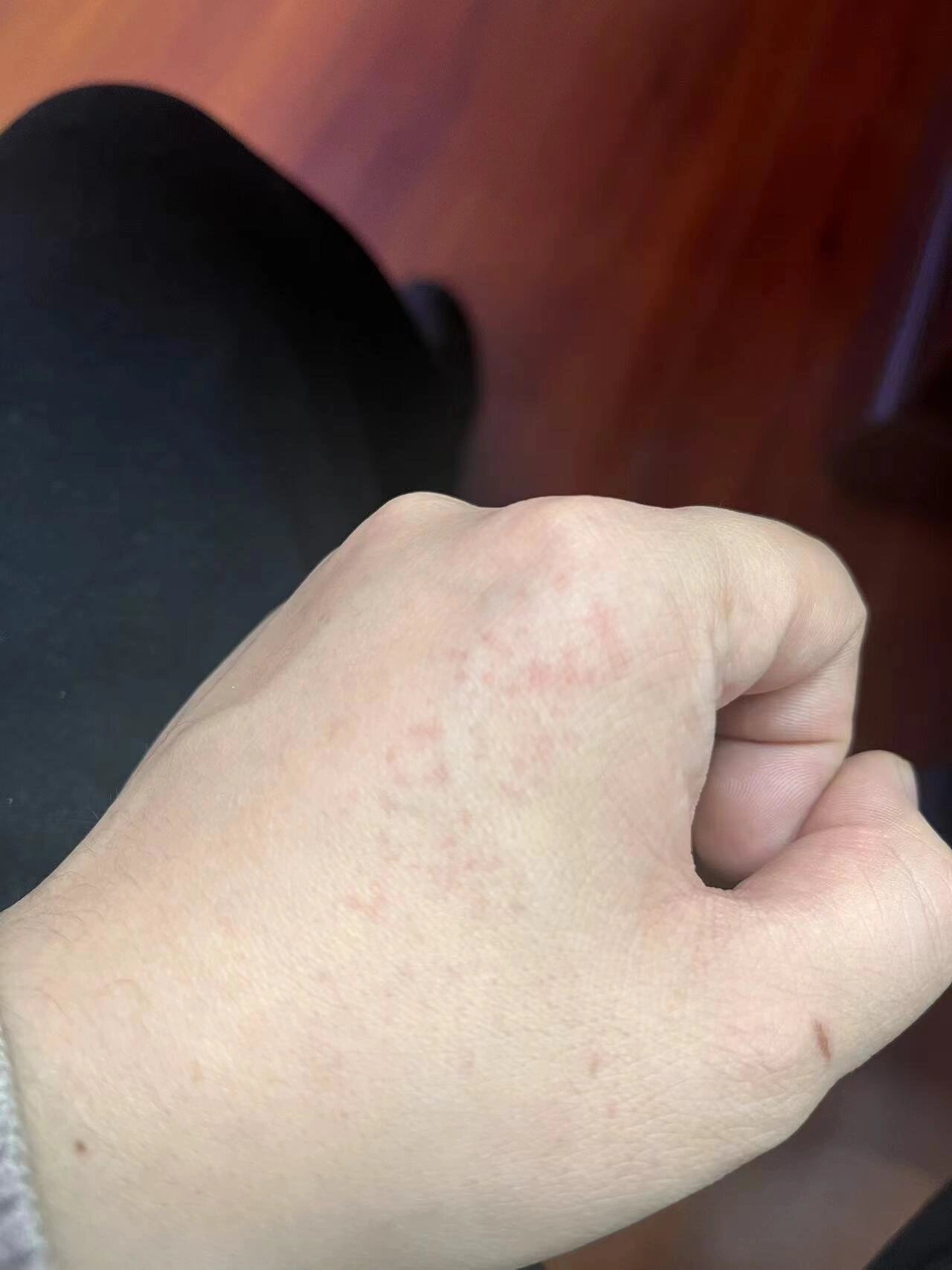 手上有小红点,不痛不痒