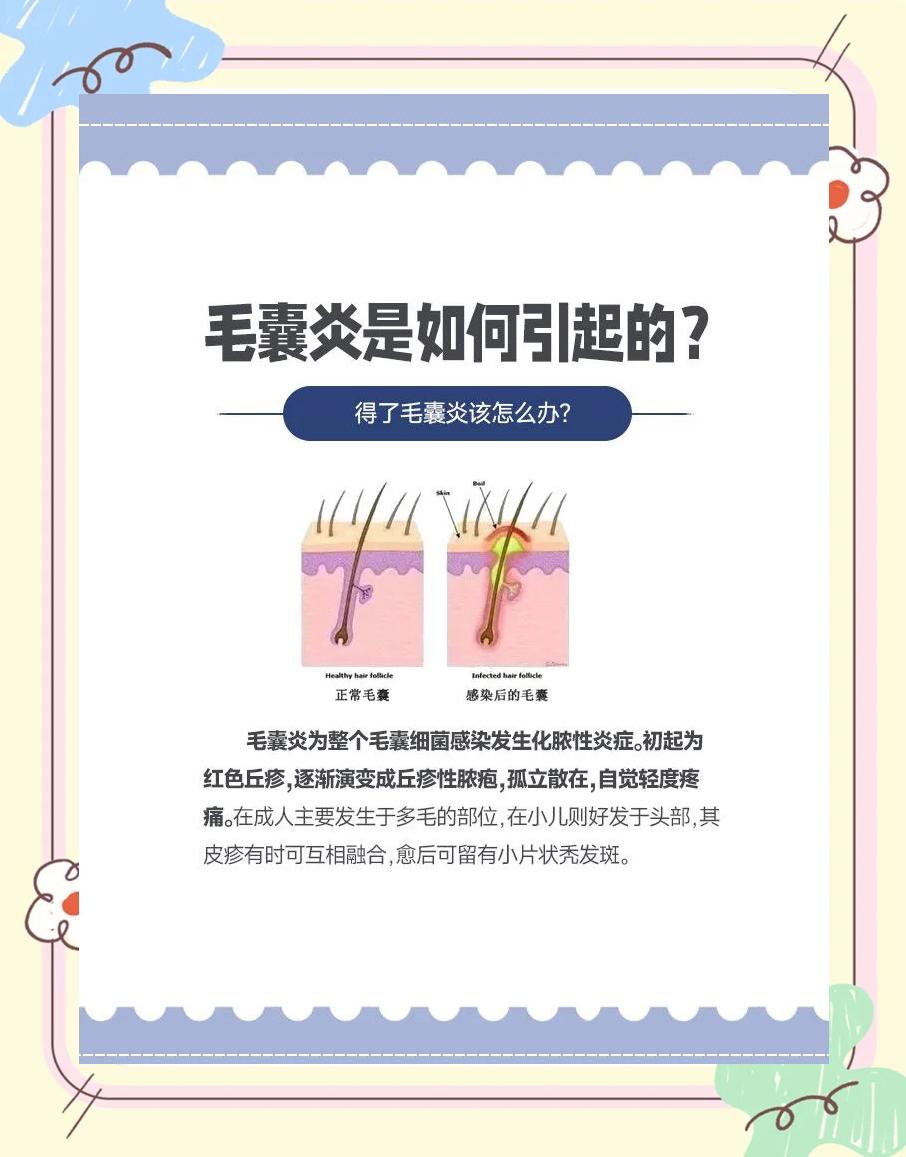毛囊炎最佳治疗方法有哪些?