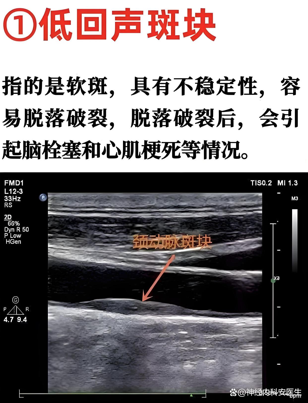 双侧颈动脉斑块形成是什么病