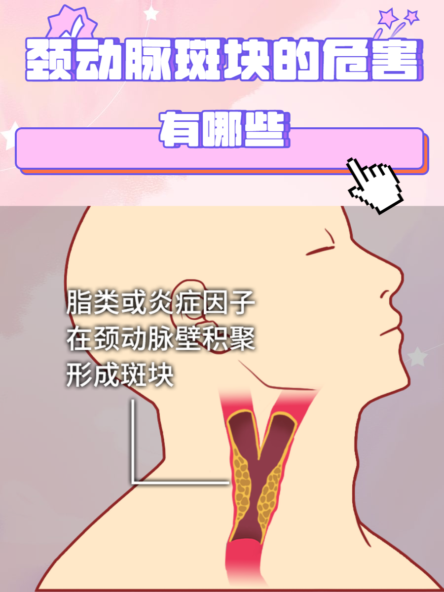 双侧颈动脉斑块形成是什么病