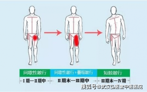 股骨头坏死怎么自测