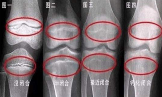 怎么判断骨骺线有没有闭合