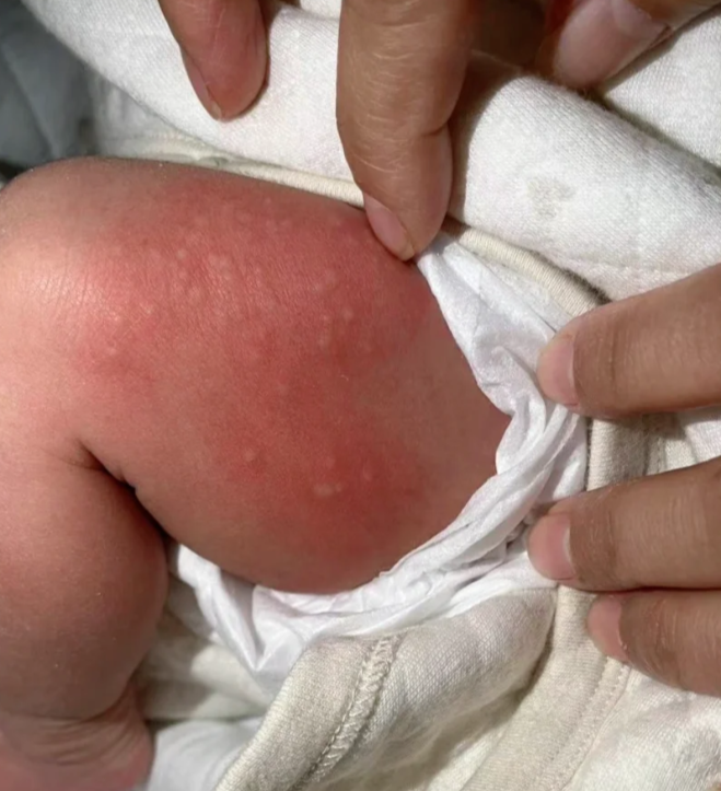 大腿内侧起了个大包怎么回事