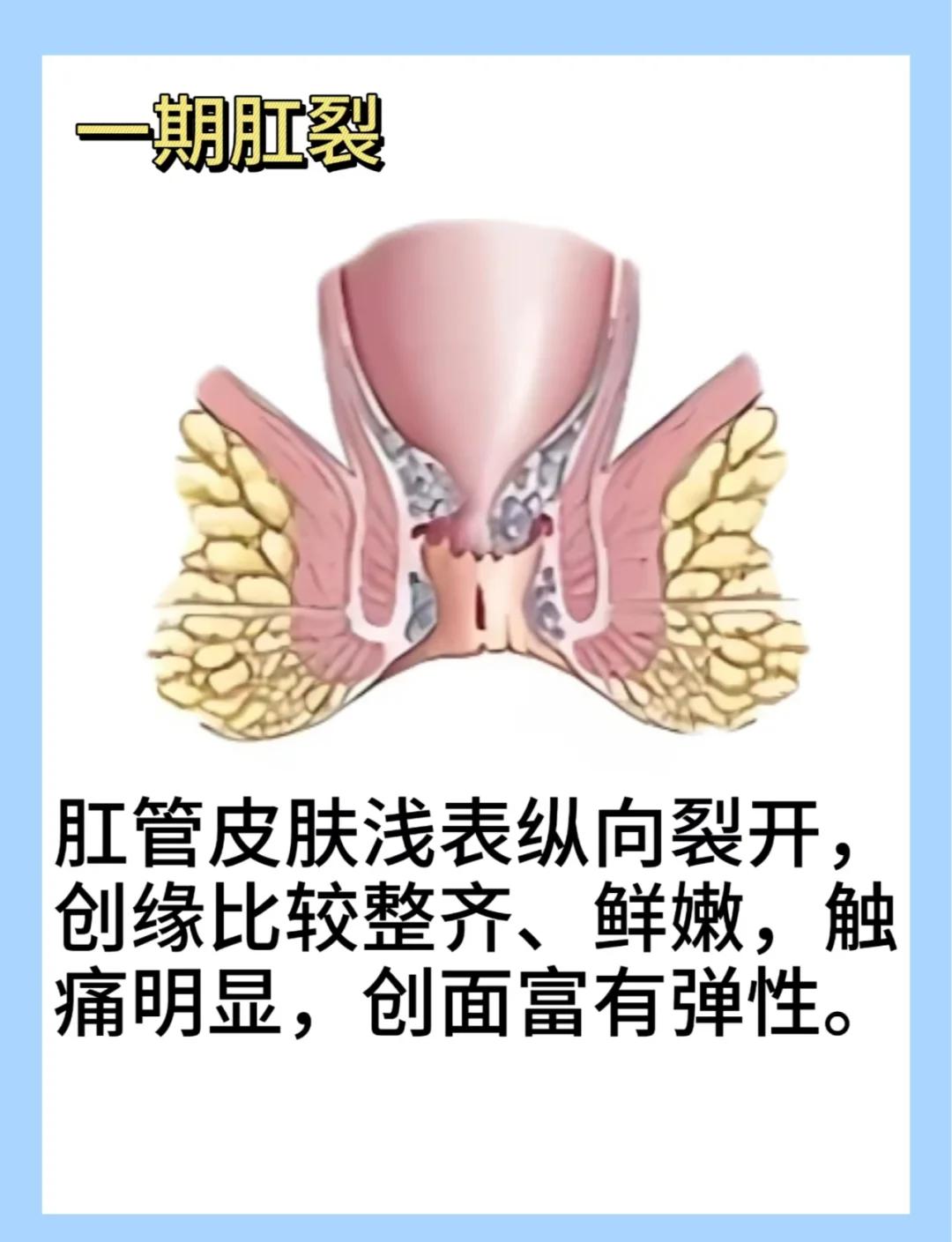 肛裂是什么原因造成的?