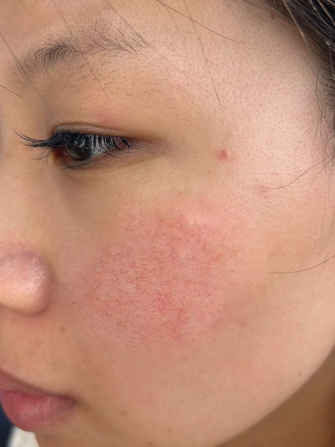 脸上有红血丝怎么办?