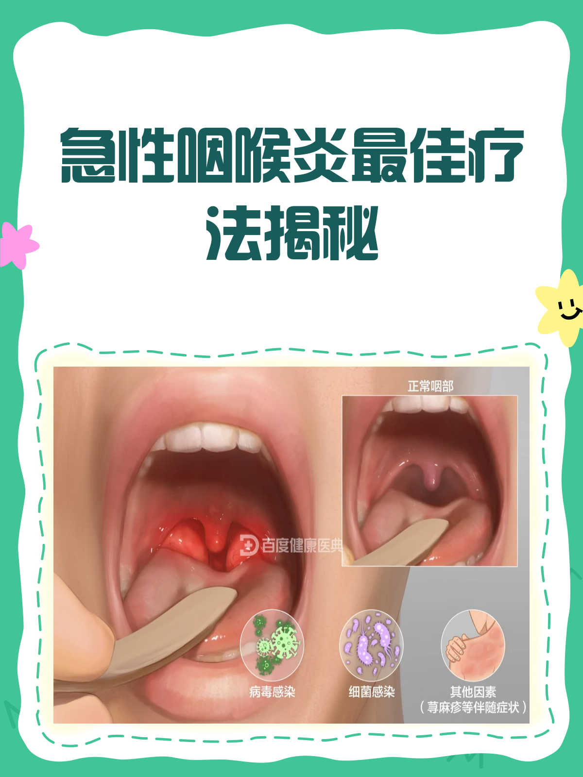 急性咽炎多久能好