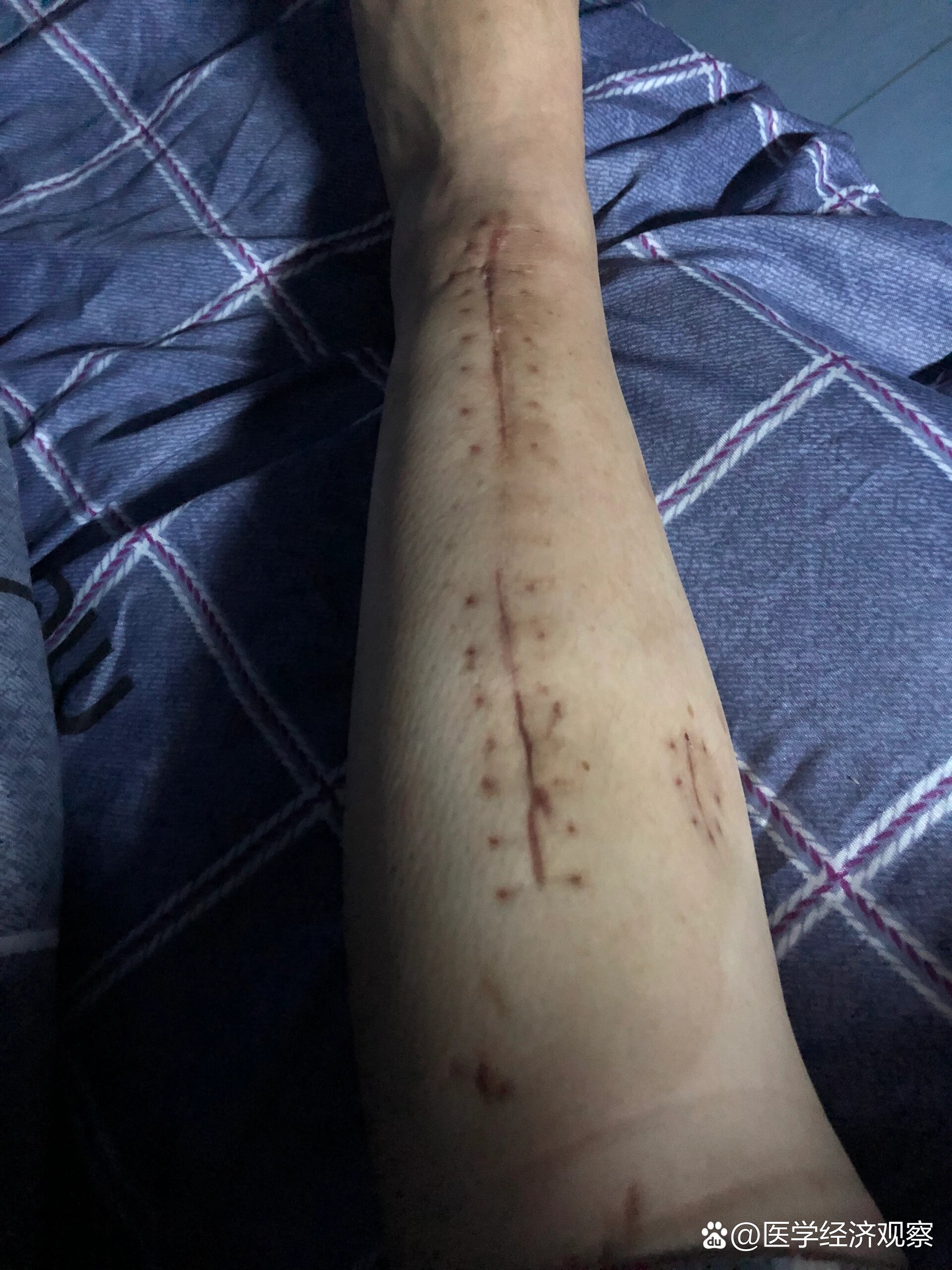 骨折取钢板很疼吗