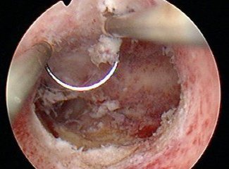 宫腔粘连有什么症状