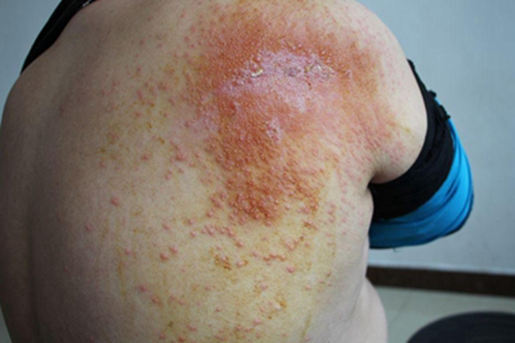 后背起疙瘩痒是艾滋病吗