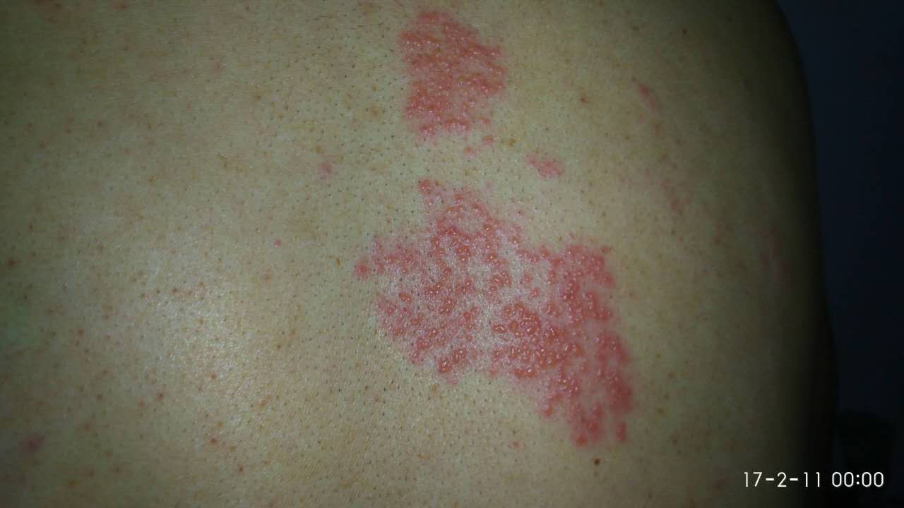 后背起疙瘩痒是艾滋病吗