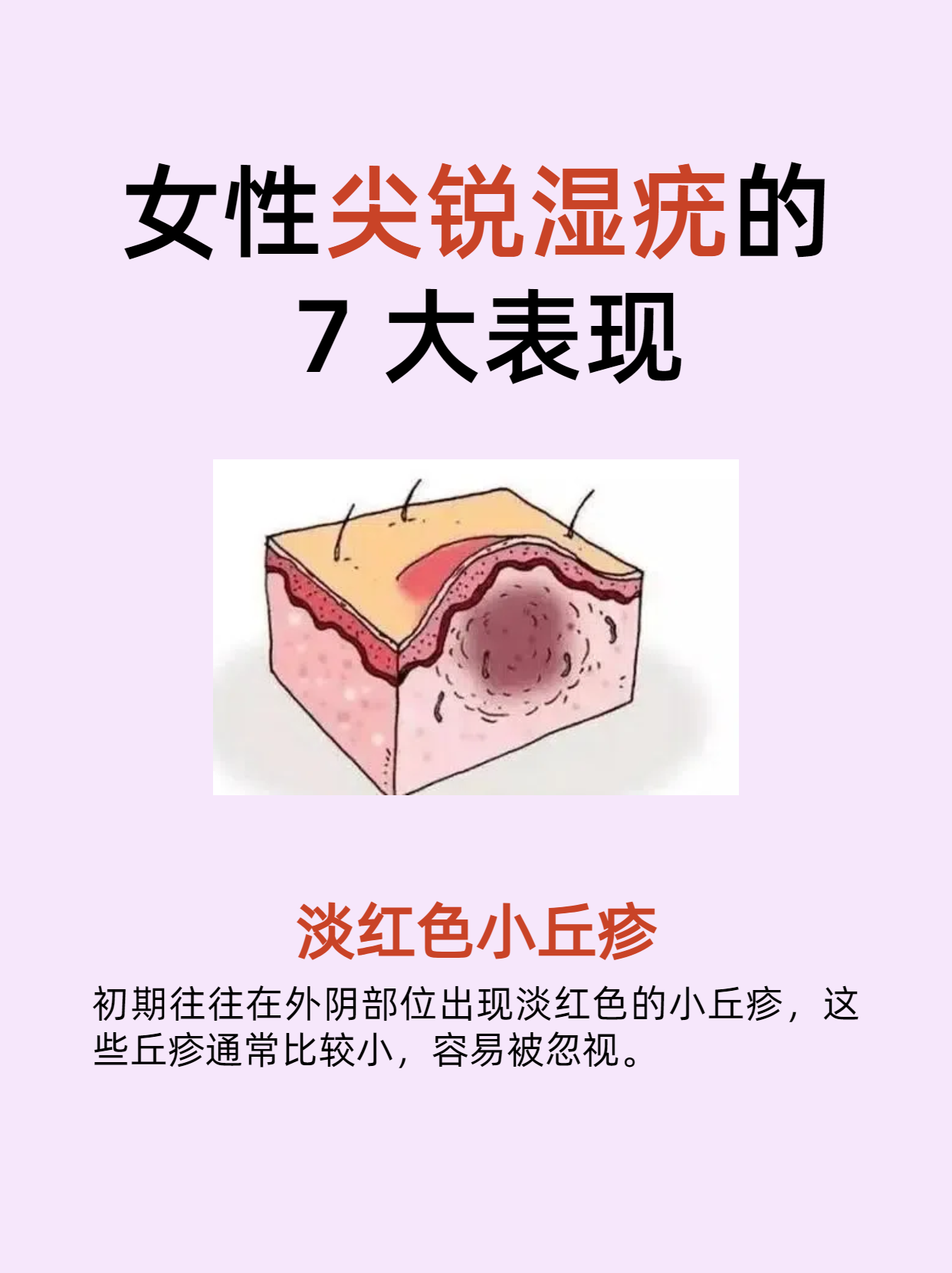 珍珠状丘疹还是尖锐湿疣?