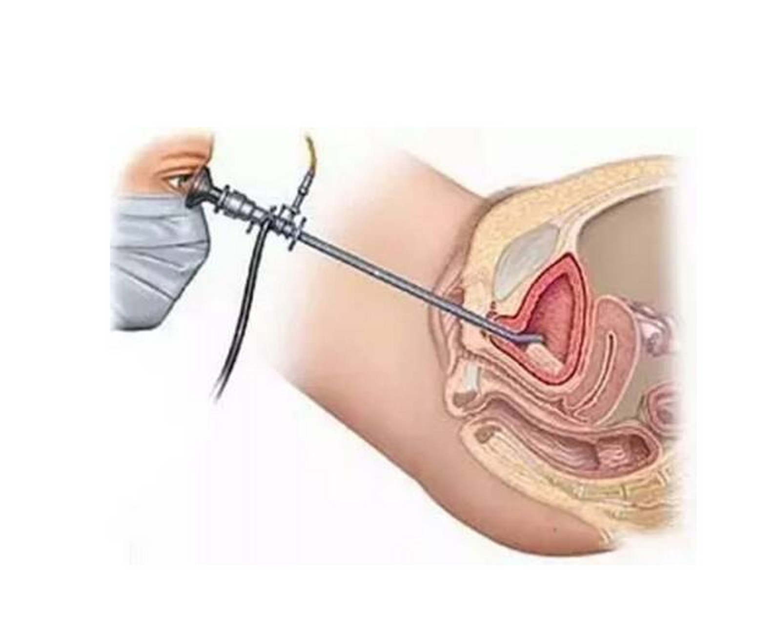 膀胱镜怎么检查