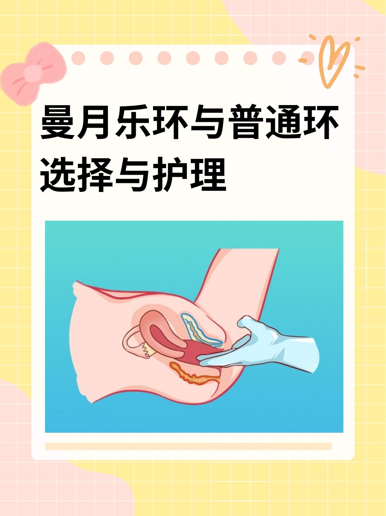 放置曼月乐环后注意事项