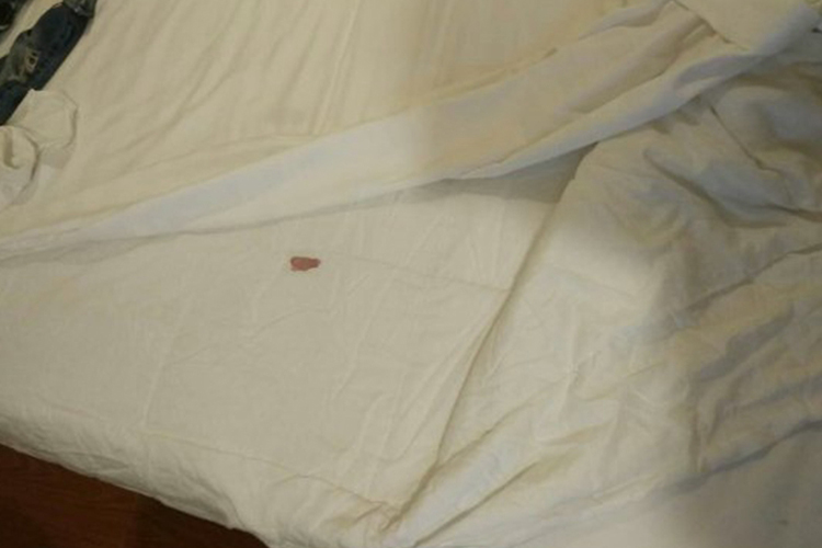 宫颈癌同房后出血图片