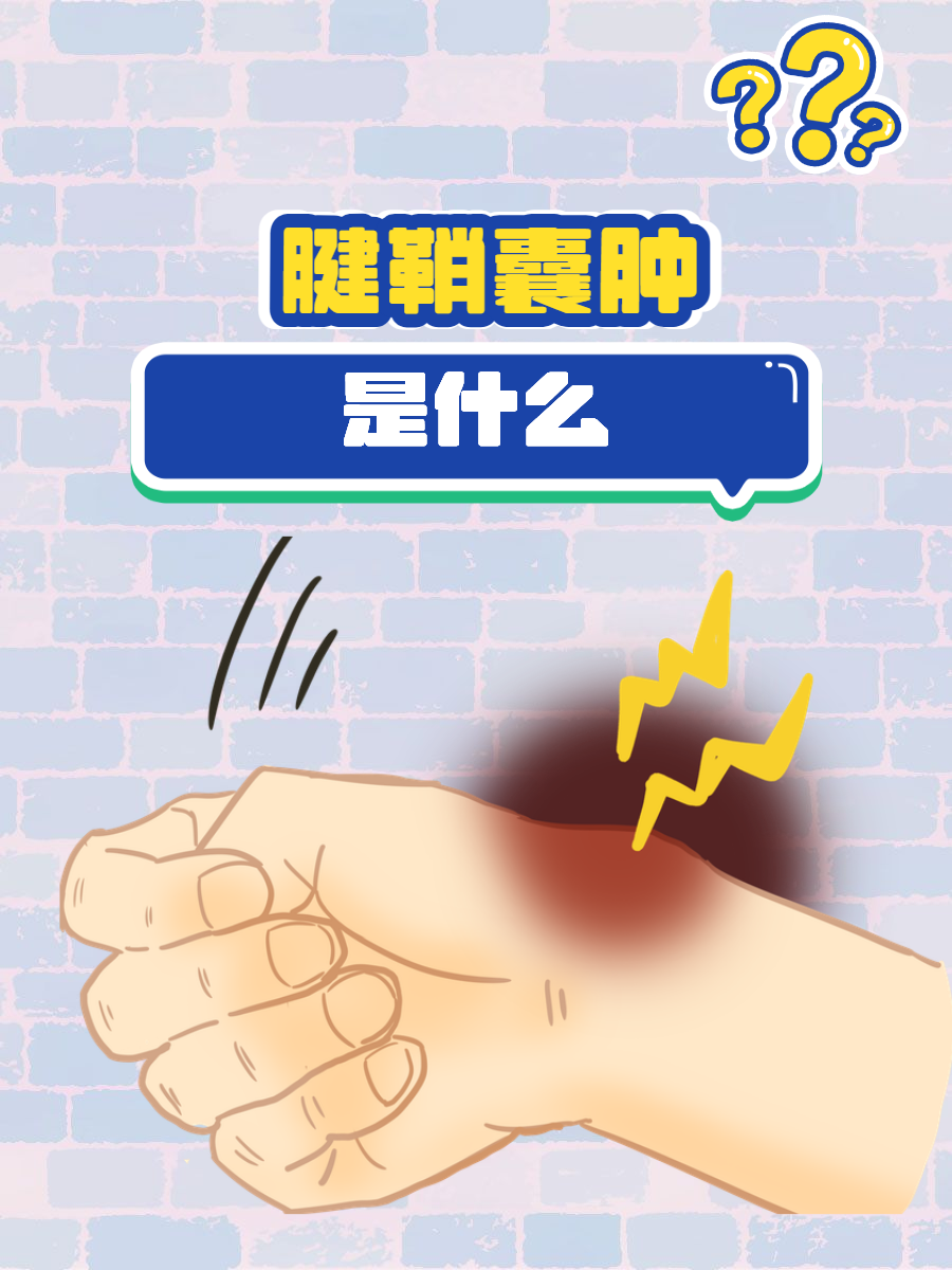 手腕腱鞘囊肿能揉吗