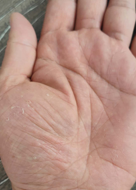 手掌心起小水泡,要怎么办.