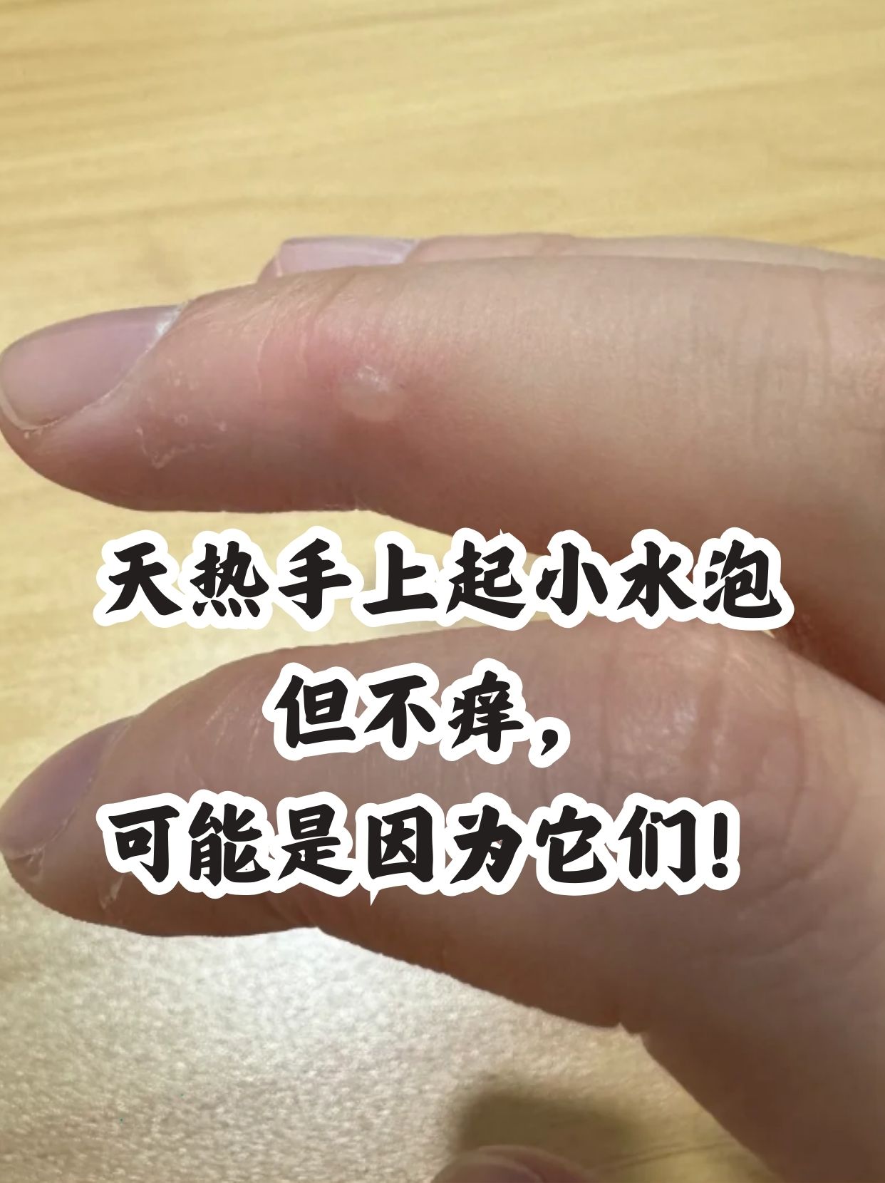 手掌心起小水泡,要怎么办.