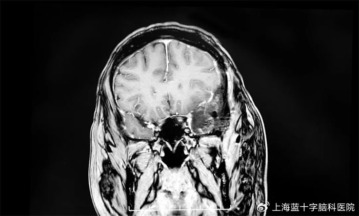 脑部肿瘤的早期症状