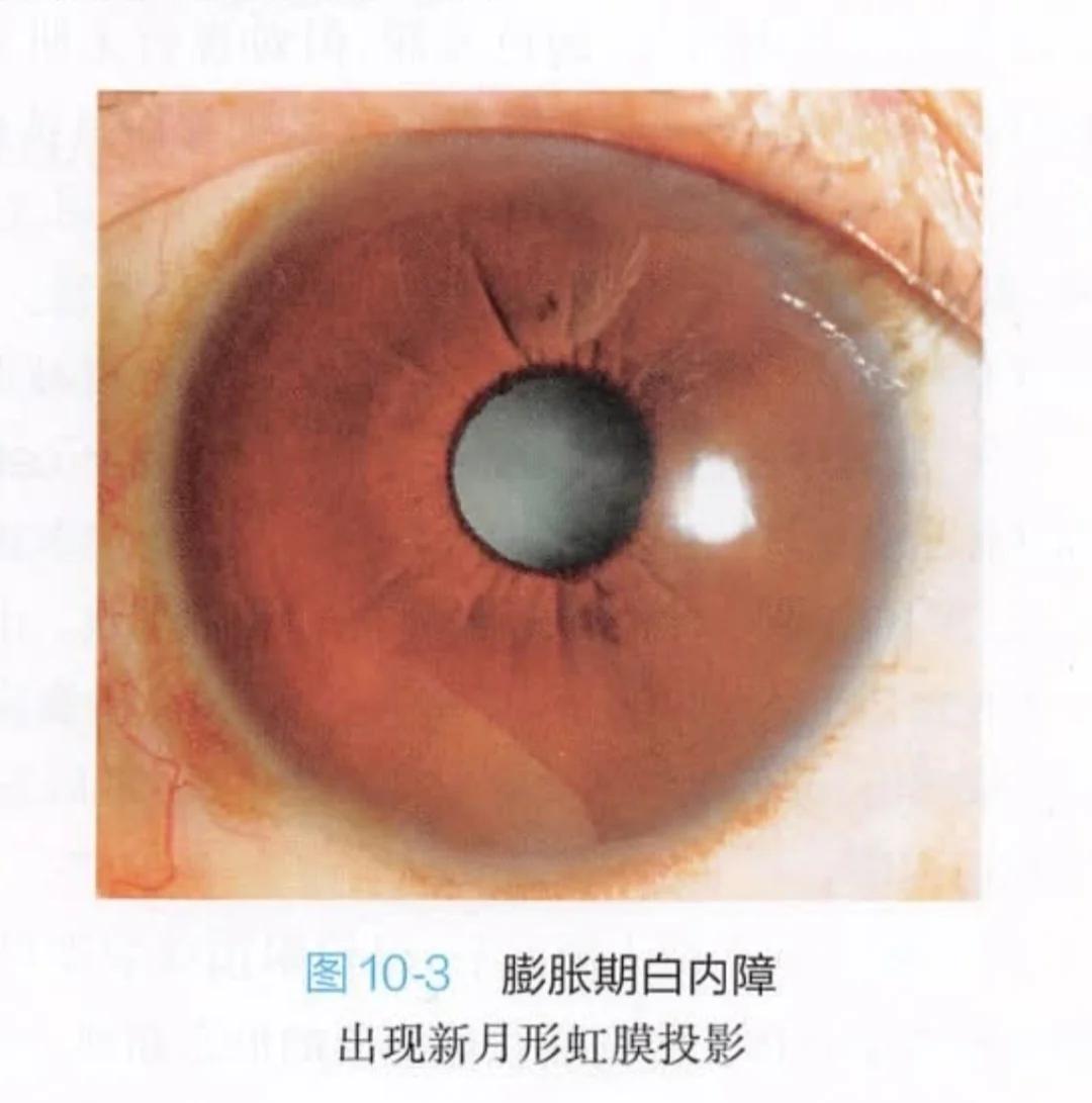 白内障的主要症状有哪些