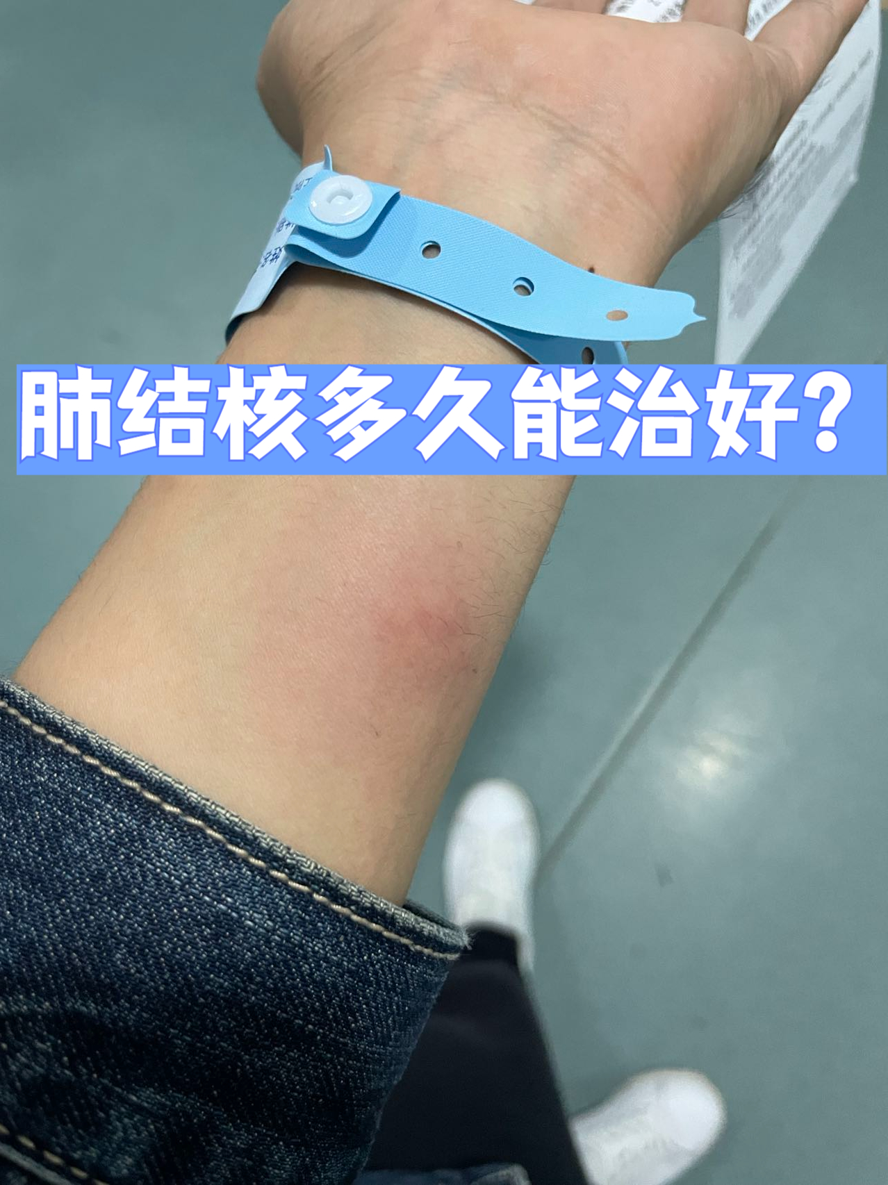 肺结核可以治疗好吗